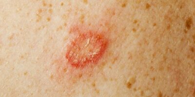 Ringworm: Penyakit Kulit Menular Pada Anak-Anak • Deherba.com