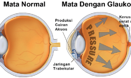 Mengenal Jenis-jenis Glaukoma Dan Proses Terbentuknya! • Deherba.com