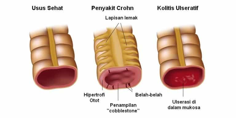 Penyakit Radang  Usus  Info Penting Seputar Peradangan di 