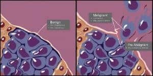 Kenali 8 Perbedaan Tumor dan Kanker yang Paling Penting • Deherba.com