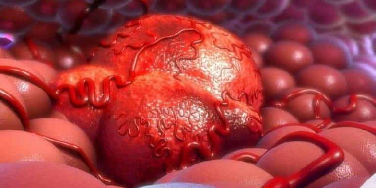 Kenali 8 Perbedaan Tumor dan Kanker yang Paling Penting • Deherba.com