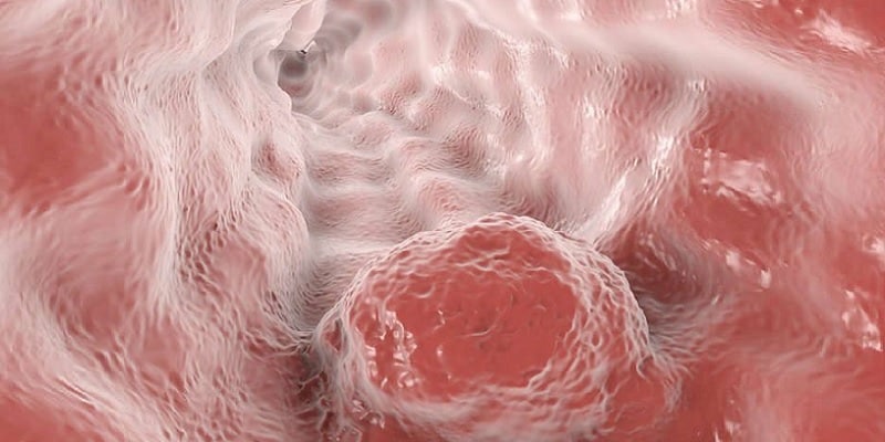 ilustrasi kanker esofagus